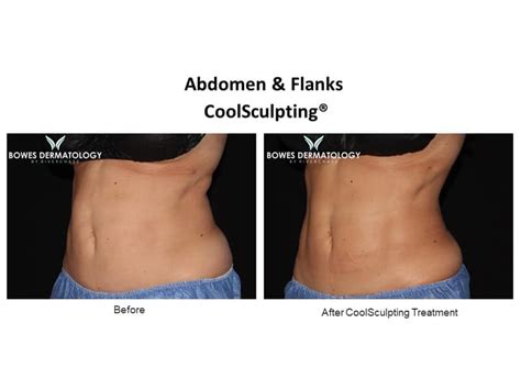 cool sculpting complaints.